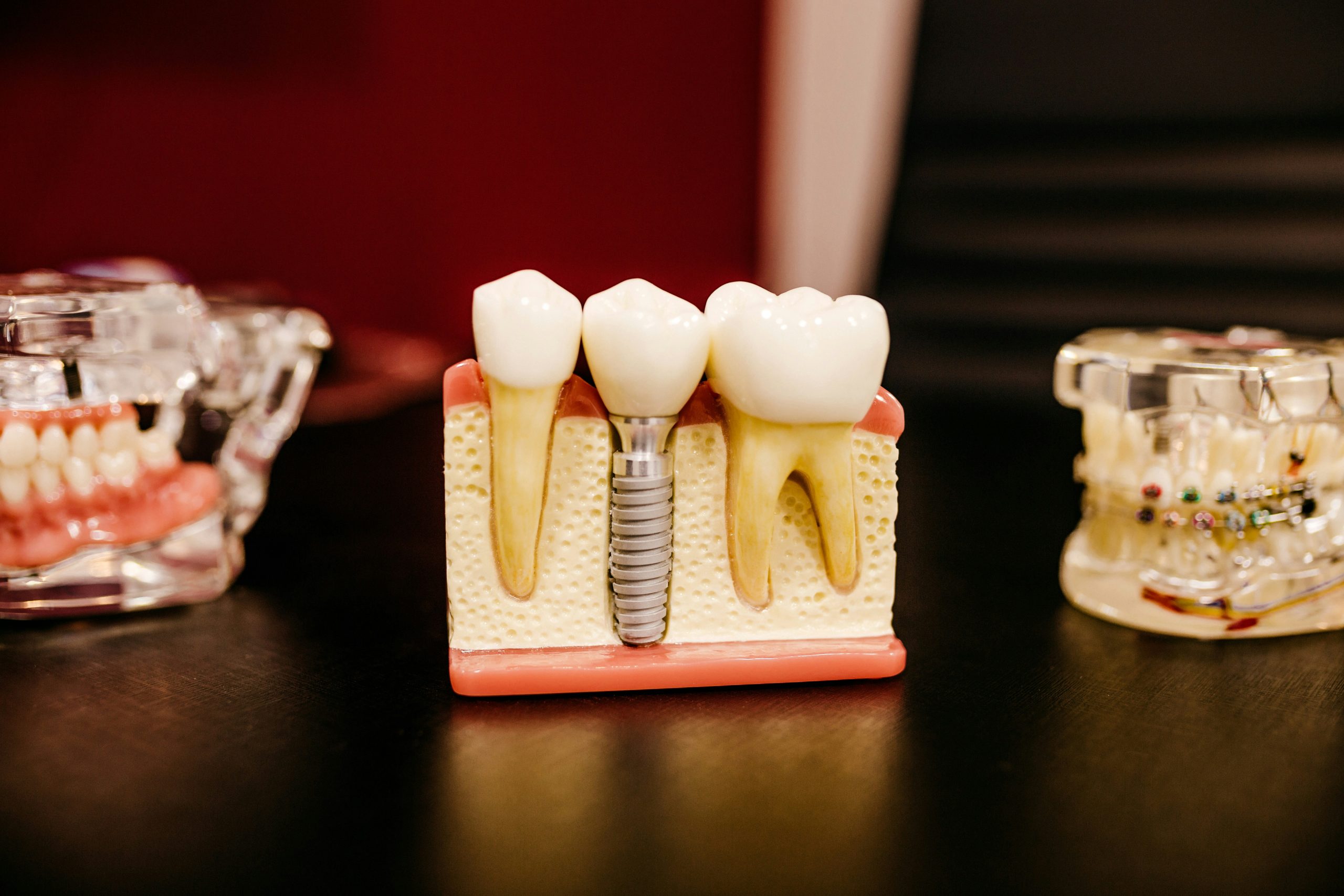 La dentiera che balla non sarà più un problema, scopri perchè